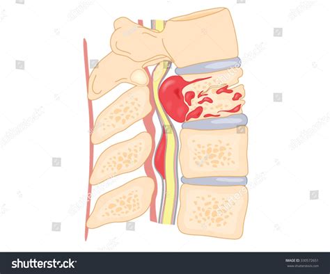 Spinal Cord Compression 的图像结果