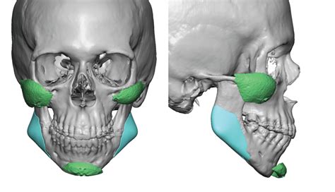 Custom Jaw Implants - Chin Implants | Eppley Custom Facial Implants