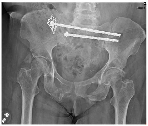 Fixation of Sacral Ala Fracture Using a Midfoot Mesh Plate as a ...