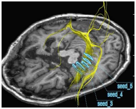 Therapeutic Inhalation of Hydrogen Gas for Alzheimer’s Disease Patients ...