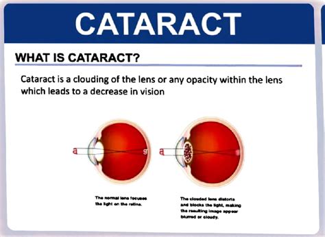 Cataract - It's a lecture note - CATARACT WHAT IS CATARACT? Cataract is ...