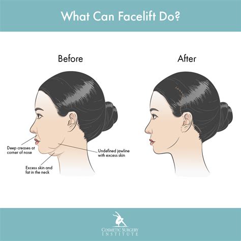 Mini Facelift Cost | Palm Desert | Cosmetic Surgery