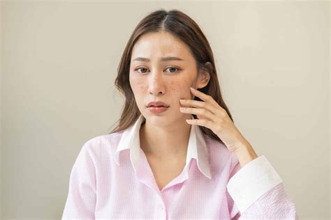 Guide to Oral Medication (Cyklokrapon Injections) for Melasma