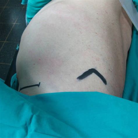 Image result for Open Chest Thoracotomy