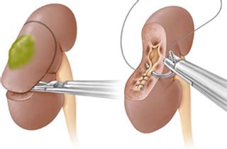 Image result for Robotic Nephrectomy Extraction Incision