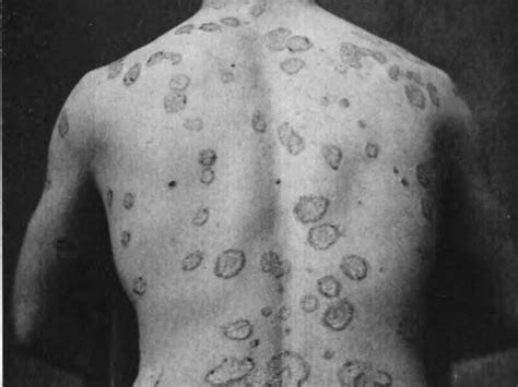 Psoriasis – Skin Consult