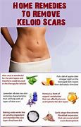 Image result for Keloid Treatment at Home