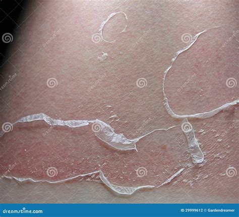 Peeling sunburn stock photo. Image of damage, epidermis - 29999612