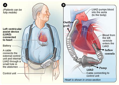Is A Life Vest A Heart Assist Device at Norman Nelson blog