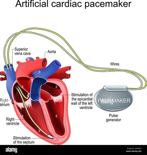 Pacemaker For Bradycardia