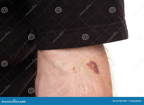 Injection Site Bruise stock image. Image of injection - 231551941