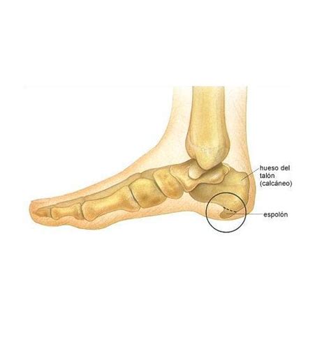 Cómo quitar un espolón - 9 pasos