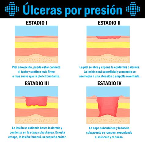 Lesiones Por Presion