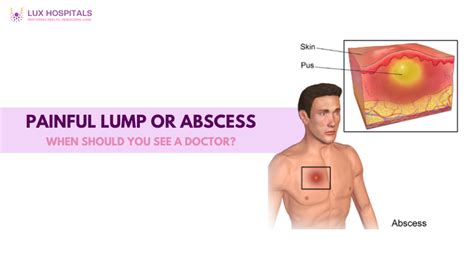 Image result for Painful Giant Abscess Exploding