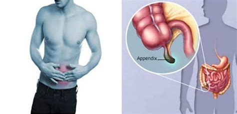 Image result for Appendix Explosion