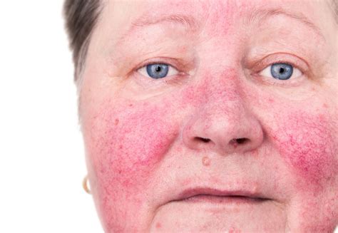 Skin Redness, Poikiloderma & Rosacea | Dermatology and Laser Centre