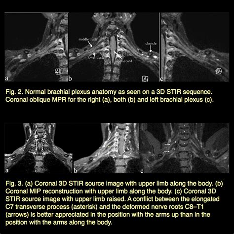 Brachial Plexus Mri