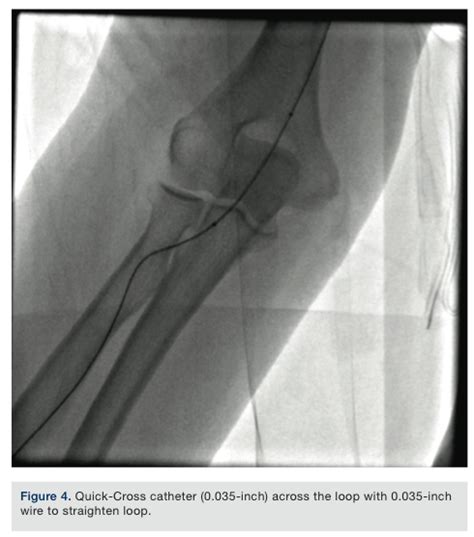Image result for Utility Radial Loop System