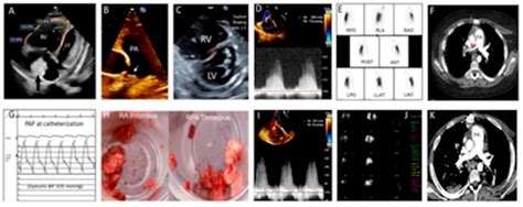 Successful Pulmonary Endarterectomy after Acute Pulmonary Embolism and ...