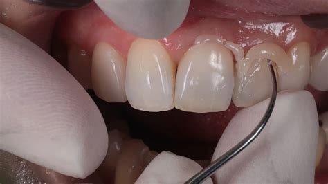 Das perfekte Paar für Einzelzahnrestaurationen | Quintessenz Verlags-GmbH