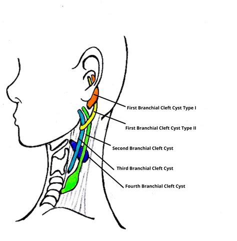 Branchial Cleft Cysts: Causes and Symptoms