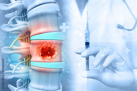 Image result for Lumbar Disc Injection