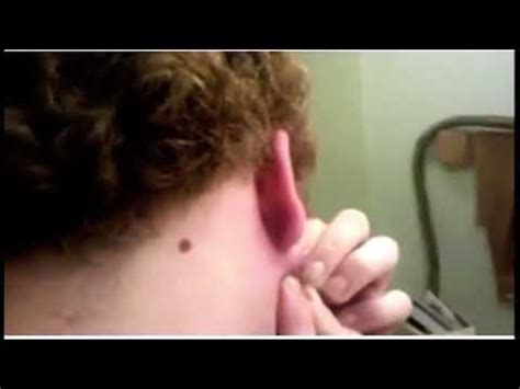 Image result for Exploding Zit Videos 2013