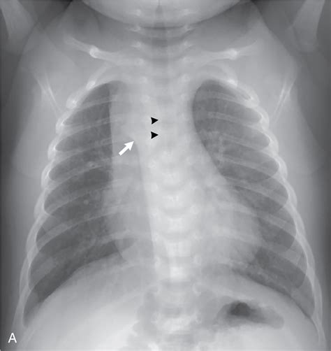 A bit of a mix-up: Right-sided aortic arch | Radiology Key