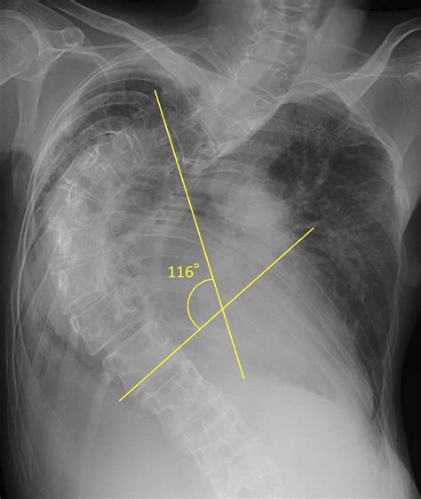 Figure and Table | Restrictive Ventilatory Impairment Due to Severe ...