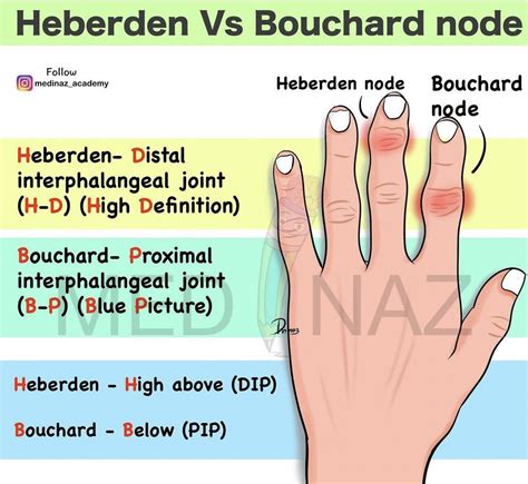 Osteoarthritis Nodes - Heberden & Bouchard Nodes