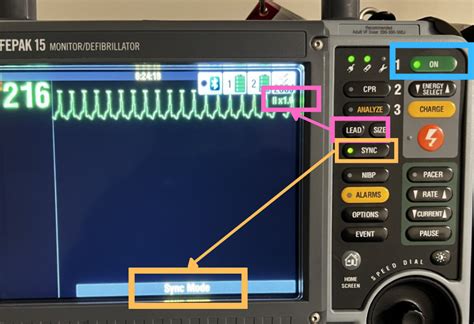 Image result for What Does Synchronized Cardioversion Do