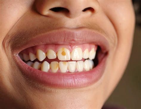 Cavities in Milk Teeth: Possible Treatment Options and Solutions ...