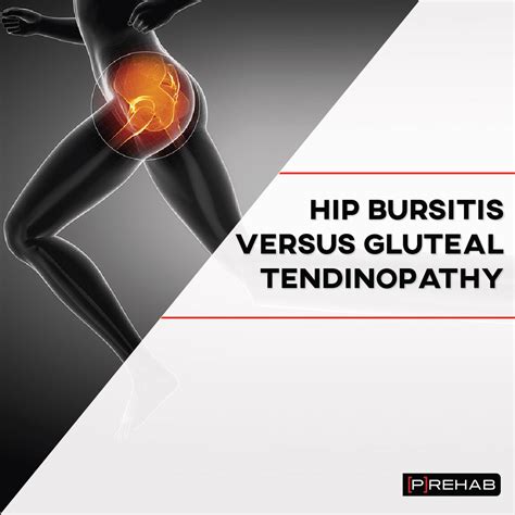 Manual Therapy For Gluteal Tendinopathy at Joshua Calyute blog