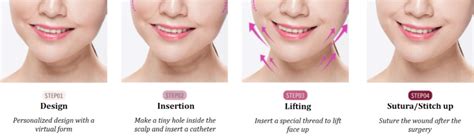 Image result for Thread Lift Procedure YouTube