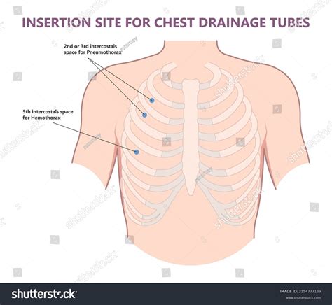 Chest Tube