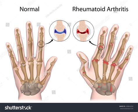 Rheumatoid Arthritis Hand Stock Illustration 228843250 - Shutterstock
