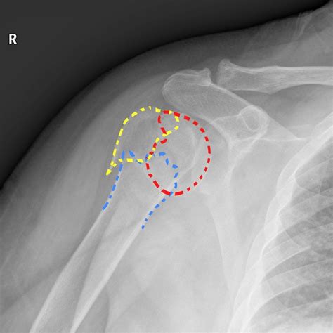 Proximal humerus fracture - wikidoc