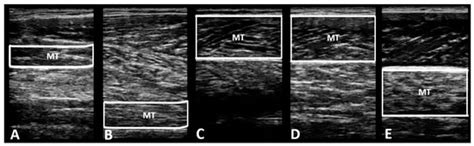 Effects of Rehabilitative Exercise and Neuromuscular Electrical ...