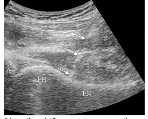 How to Perform Hip Ultrasound 的图像结果