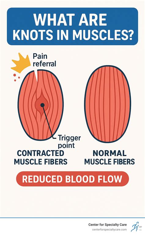 What are knots in muscles: Ultimate Relief 2025