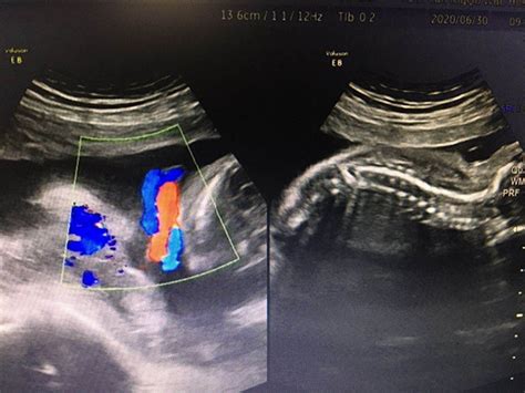 产前超声之胎儿脐带绕颈 - 孕产保健 - 宜宾市翠屏区妇幼保健院