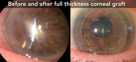 Keratoconus Corneal Transplant