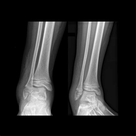 Salter-Harris Fracture | Pediatric Radiology Reference Article | Pediatric Imaging | @pedsimaging