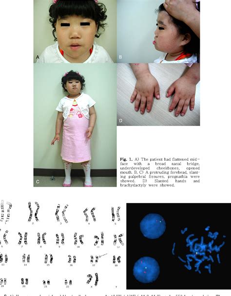 Figure 1 from Two cases of Smith-Magenis syndrome | Semantic Scholar