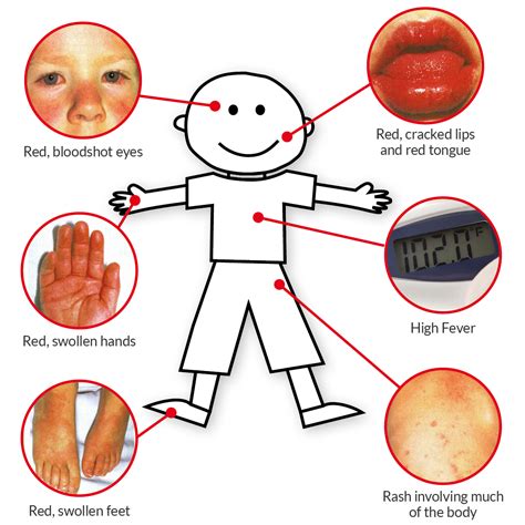 Kawasaki Disease - EMSEKFLOL.COM