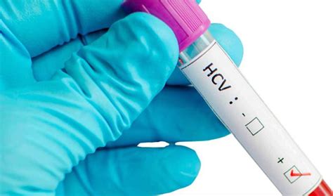 Stage set for access to Hepatitis C treatment | The Star