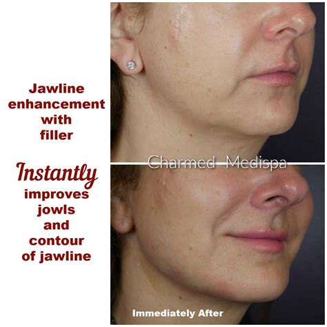 Improve Jowls Without Surgery at Charmed Medispa in Delaware – Charmed Medispa