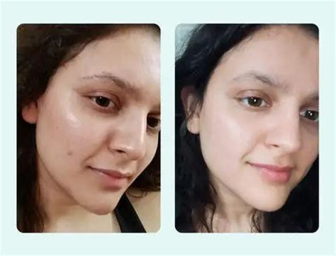 Salicylic Acid: Everything You Need To know – DERMATOUCH