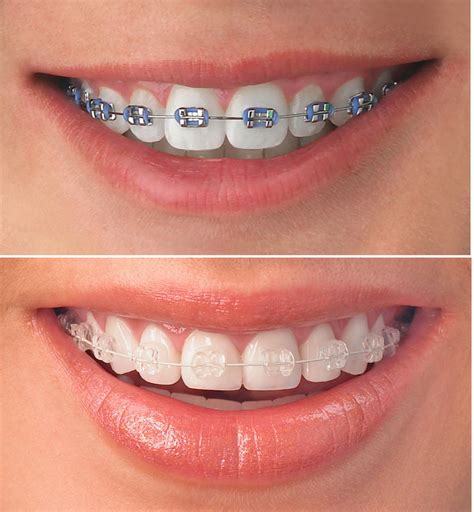 Best Braces Treatment | Expert Dentist Dr. Rohan Virani Mulund