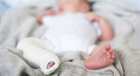 Clubfoot in Newborns: Understanding the Deformity, Prevention, and ...